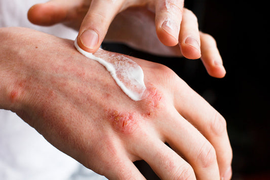 Dermatitis. Vrste, uzroci i preparat na bazi kolagena kao pomoć