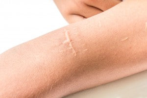 Najdelotvornija nega ožiljaka počinje sa ribljim kolagenom