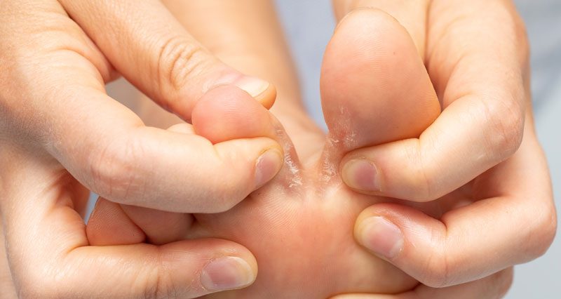 Atletsko stopalo – Kako ga prepoznati i efikasno lečiti