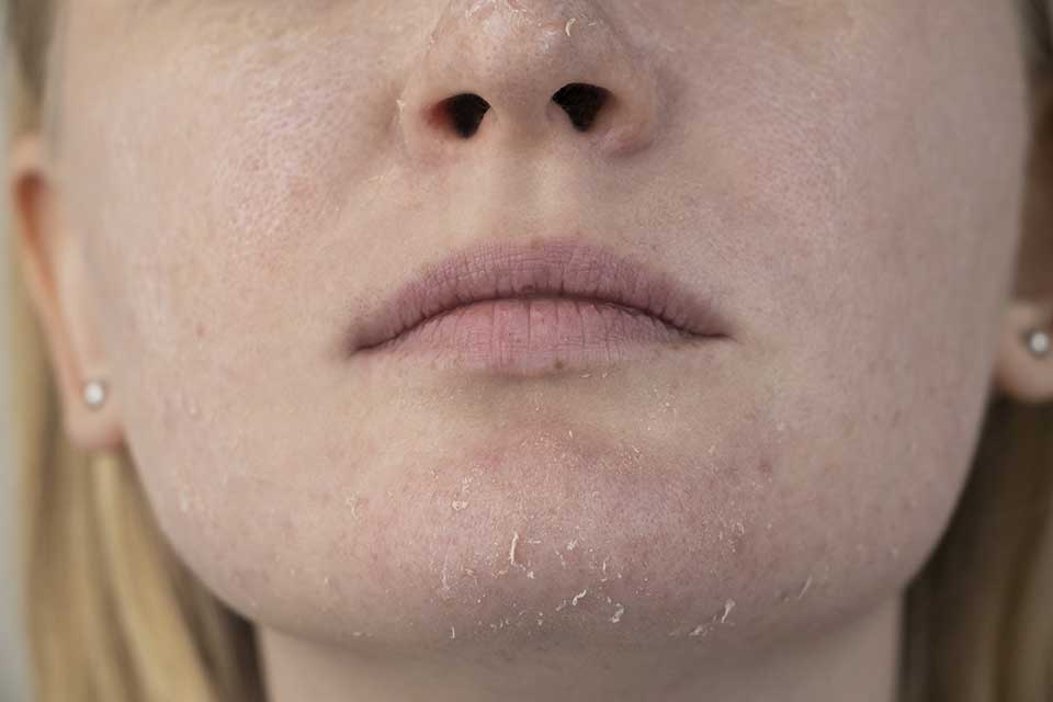 Rešite se suve kože oko usana i brade uz pomoć ribljeg kolagena